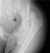 Hip dislocationFigure 1_Posterior dislocation of the hip Hip dislocationFigure 1_Posterior dislocation of the hip